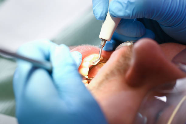 Best Emergency Treatment for Dental Infections or Abscesses in Sun Village, CA
